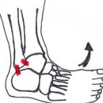 Verstuikte enkel verzwikte enkel